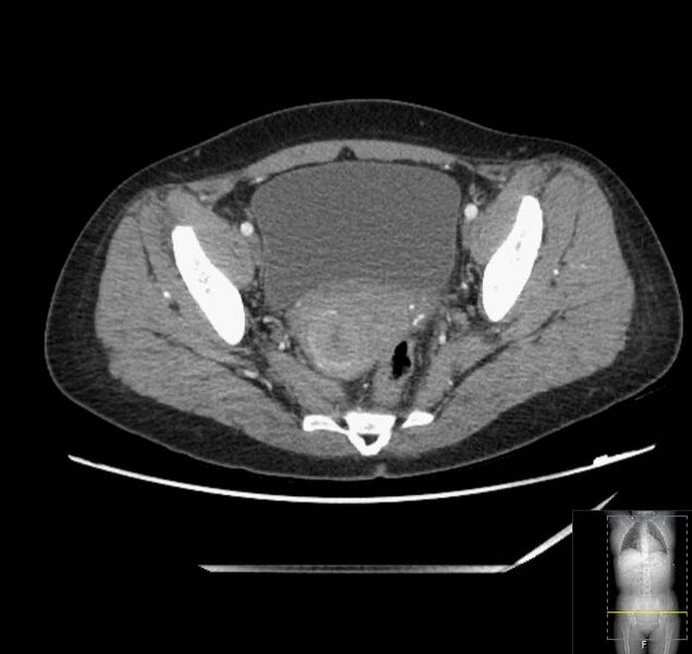 File:Appendicitis (CT angiogram) (Radiopaedia 154713-127660 Axial 34).jpg