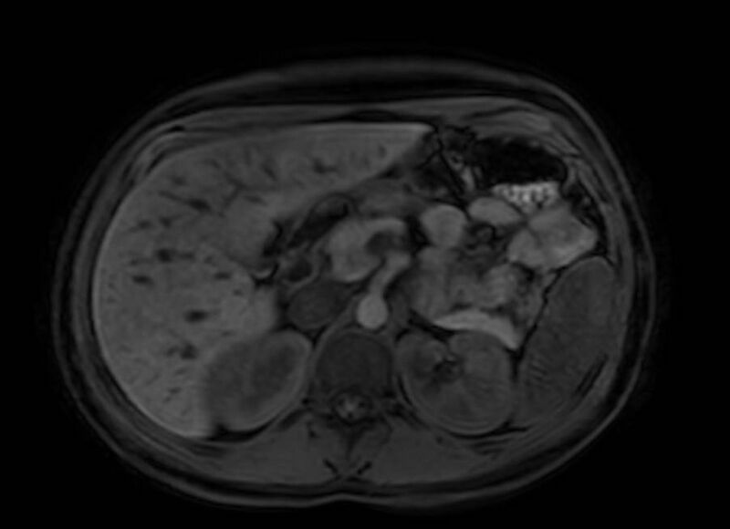 File:Appendicitis in gravida (MRI) (Radiopaedia 89433-106395 Axial DIXON 36).jpg
