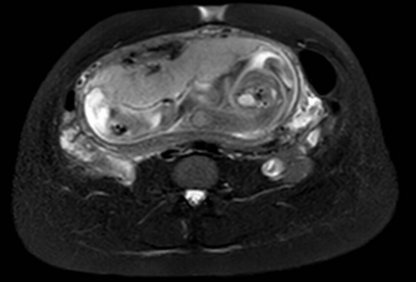 Appendicitis in gravida (MRI) (Radiopaedia 89433-106395 Axial T2 SPAIR 44).jpg