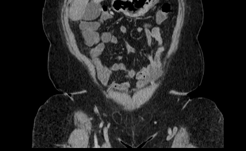 Appendix mucocele (Radiopaedia 41222-44033 B 7).jpg