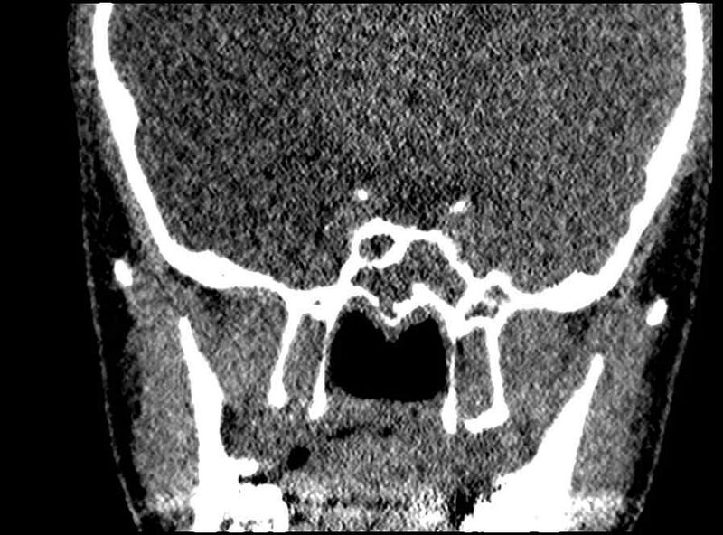 File:Arachnoid cyst- extremely large (Radiopaedia 68741-78450 Coronal bone window 18).jpg