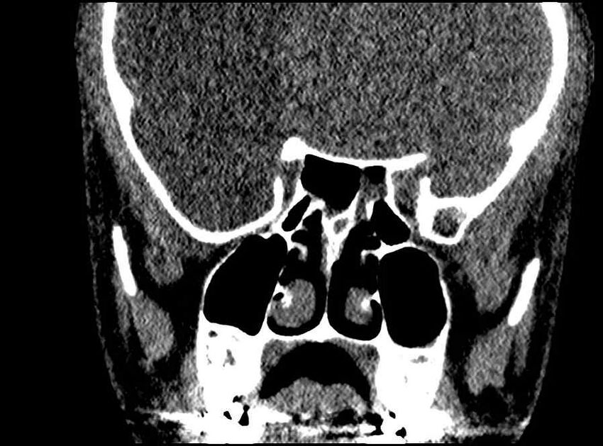 Arachnoid cyst- extremely large (Radiopaedia 68741-78450 Coronal bone window 34).jpg