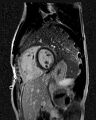 Arrhythmogenic right ventricular cardiomyopathy (Radiopaedia 57972-64966 D 7).jpg