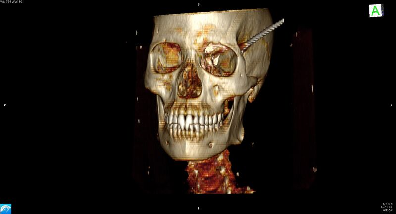 File:Arrow injury to the head (Radiopaedia 75266-86388 3D horizontal 4).jpg