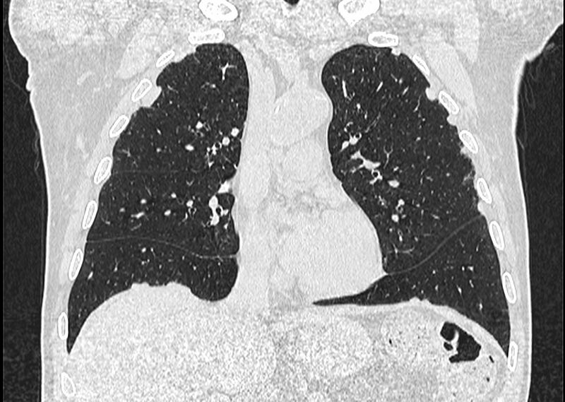 File:Asbestos pleural placques (Radiopaedia 57905-64872 Coronal lung window 119).jpg