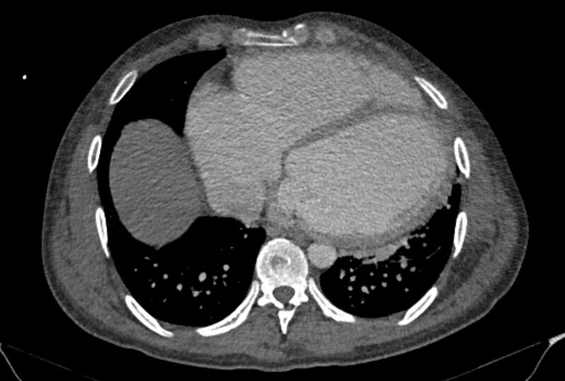 File:Ascending aortic aneurysm (Radiopaedia 86279-102297 C 46).jpg