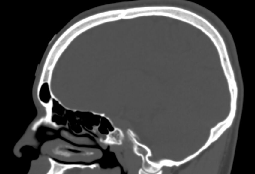 Asymptomatic occipital spur (Radiopaedia 87753-104201 Sagittal bone window 128).jpg