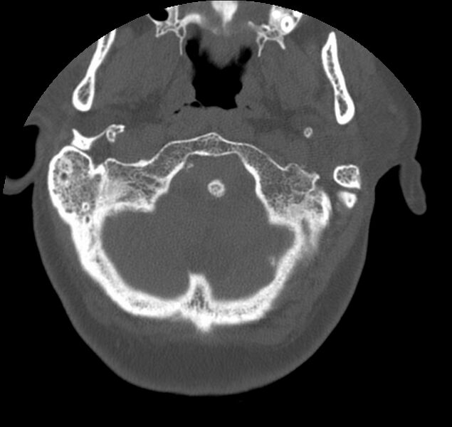 File:Atlanto-occipital assimilation with basilar invagination (Radiopaedia 70122-80188 Axial bone window 10).jpg