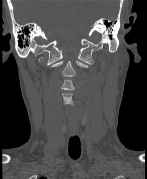 File:Atlanto-occipital assimilation with basilar invagination (Radiopaedia 70122-80188 Coronal bone window 69).jpg