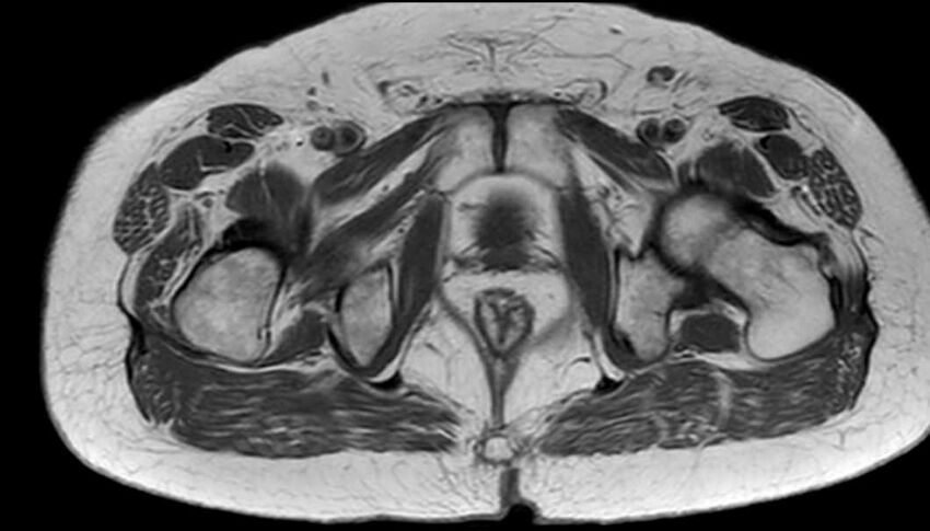 Atypical lipomatous tumor - thigh (Radiopaedia 68975-78734 Axial T1 88).jpg