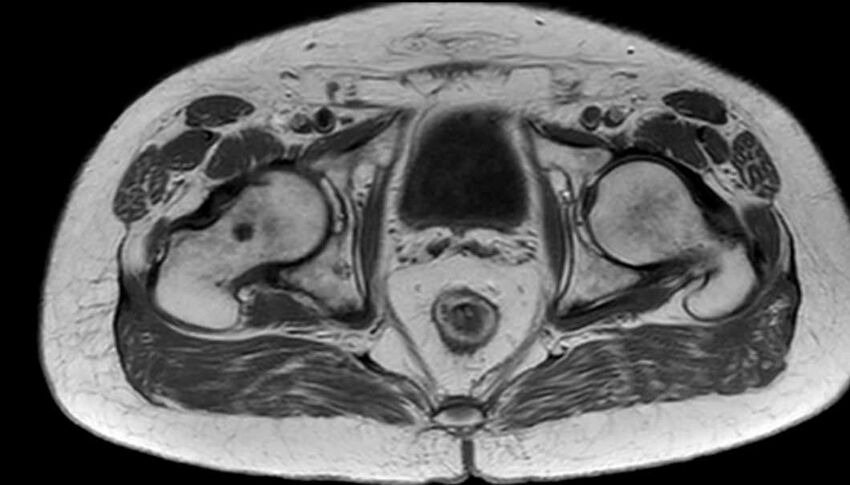 Atypical lipomatous tumor - thigh (Radiopaedia 68975-78734 Axial T1 91).jpg