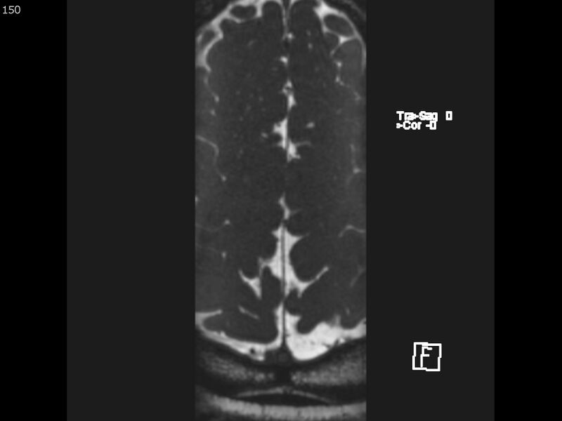 File:Atypical meningioma - intraosseous (Radiopaedia 64915-74572 Axial CISS 150).jpg