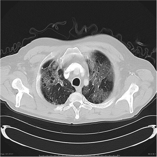 File:Atypical pneumonia - Q fever (Radiopaedia 21993-21989 lung window 6).jpg