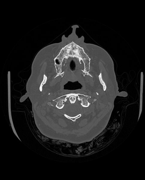 File:Automastoidectomy with labyrinthine fistula (Radiopaedia 84143-99411 Axial non-contrast 39).jpg