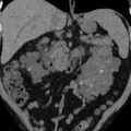 Autosomal dominant polycystic kidney disease (Radiopaedia 36539-38101 Coronal non-contrast 16).jpg