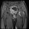 Avascular necrosis of the hip (Radiopaedia 29563-30067 I 9).jpg