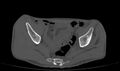 Avascular necrosis of the left hip (Radiopaedia 75068-86125 Axial bone window 3).jpg