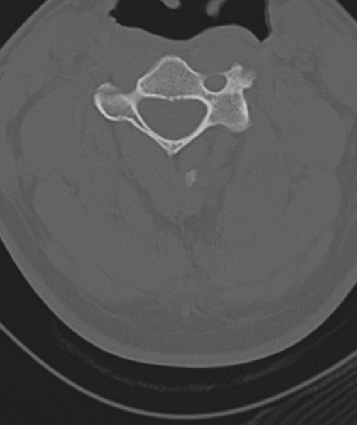 File:Axis peg fracture (type 3) and atlas lateral mass (type 4) fracture (Radiopaedia 37474-39324 Axial bone window 26).png