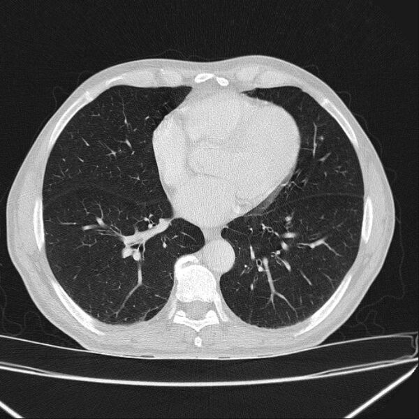 File:Azygos lobe (Radiopaedia 38259-40275 Axial lung window 53).jpg
