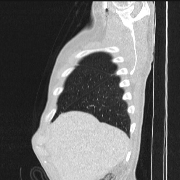 File:Azygos lobe (Radiopaedia 38259-40275 lung window 15).jpg