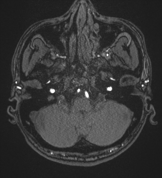 File:Basal ganglia subacute infarct (Radiopaedia 80201-93521 Axial MRA 1).png