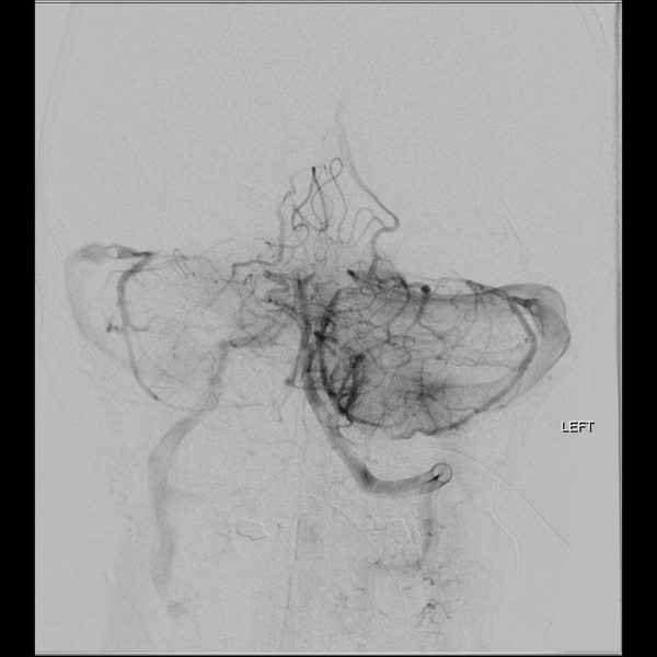 File:Basilar tip thrombus with endovascular clot retrieval (Radiopaedia 46320-50726 B 17).png