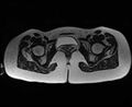 Bicornuate bicollis uterus (Radiopaedia 61626-69616 Axial T2 33).jpg