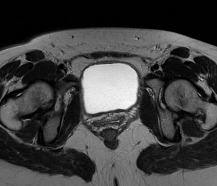 File:Bicornuate uterus (Radiopaedia 76407-88114 Axial T2 23).jpg