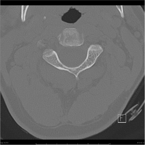 File:Bilateral cervical ribs (Radiopaedia 25868-26017 Axial bone window 16).jpg