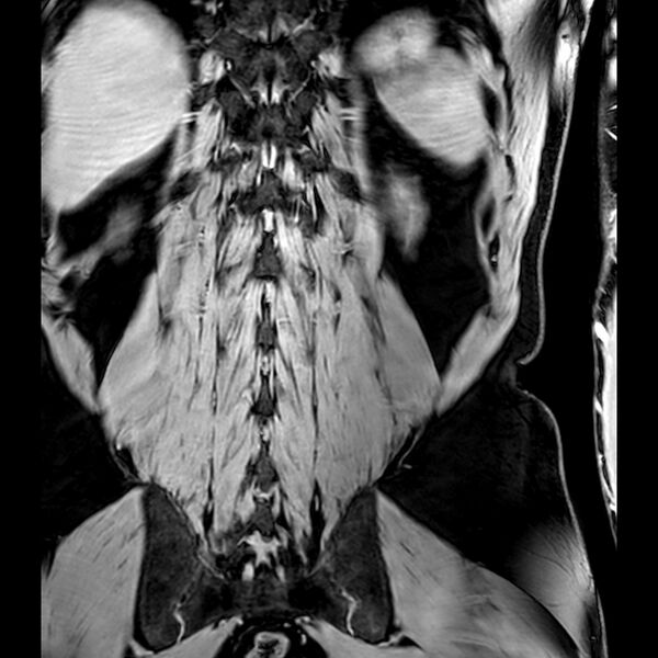 File:Bilateral conjoined nerve roots at different levels (Radiopaedia 73312-84063 B 42).jpg