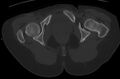 Bilateral mature cystic ovarian teratoma (Radiopaedia 88821-105592 Axial bone window 57).jpg