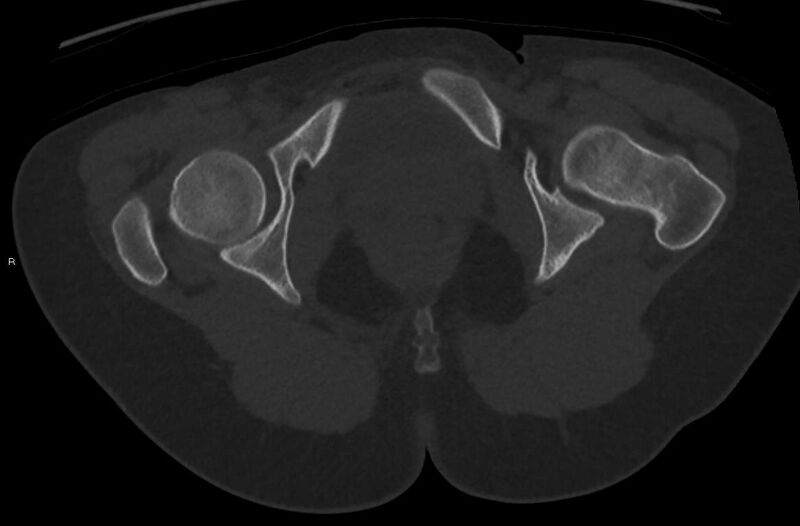 File:Bilateral mature cystic ovarian teratoma (Radiopaedia 88821-105592 Axial bone window 57).jpg