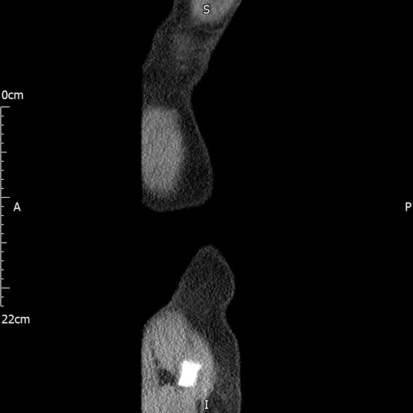 Bilateral medullary nephrocalcinosis with ureteric calculi (Radiopaedia 71269-81569 C 7).jpg