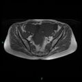 Bilateral ovarian fibroma (Radiopaedia 44568-48293 Axial T1 11).jpg