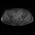 Bilateral ovarian fibroma (Radiopaedia 44568-48293 Axial T1 C+ fat sat 12).jpg