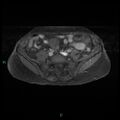 Bilateral ovarian fibroma (Radiopaedia 44568-48293 Axial T1 C+ fat sat 3).jpg