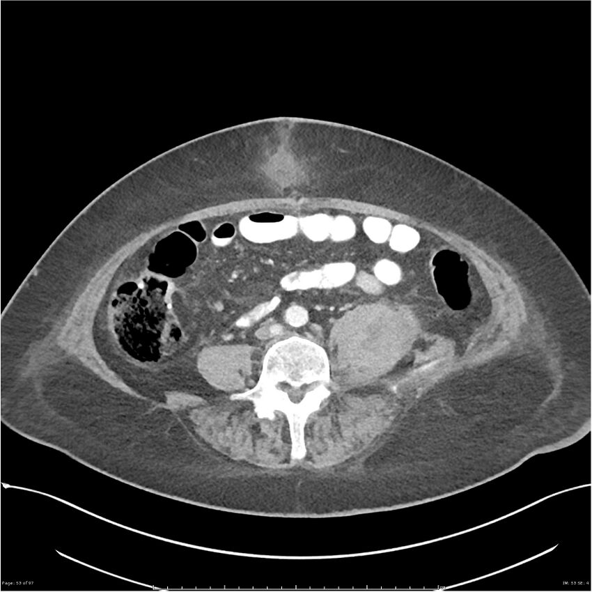 Bilateral psoas hematomas (Radiopaedia 24057-24279 A 53).jpg