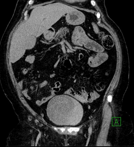 File:Bilateral sporadic synchronous clear cell renal cell carcinoma (Radiopaedia 85035-100575 I 12).jpg