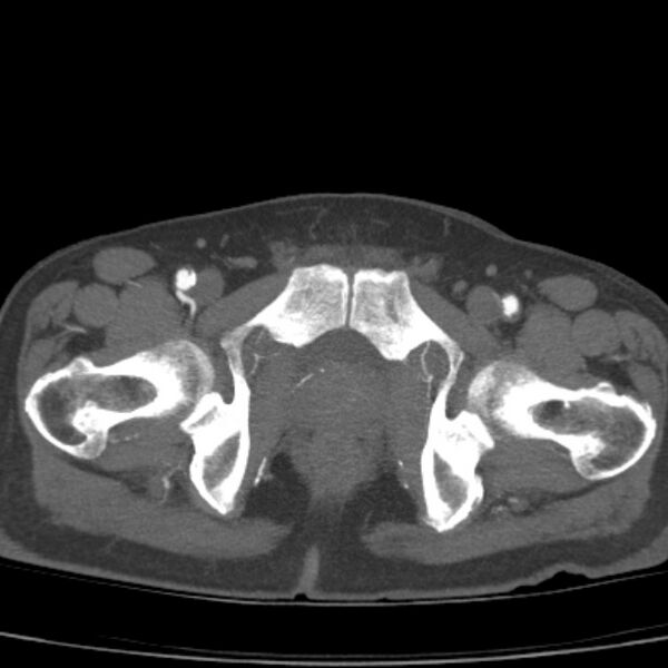 File:Bilateral superficial femoral arterial occlusion (Radiopaedia 25682-25857 A 27).jpg