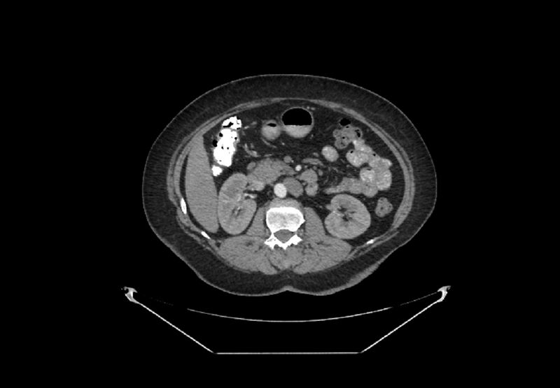 File:Bilateral urolithiasis with incidentally detected splenic artery aneurysm and left inferior vena cava (Radiopaedia 44467-48127 A 45).jpg