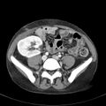 Biliary necrosis - liver transplant (Radiopaedia 21876-21846 B 53).jpg