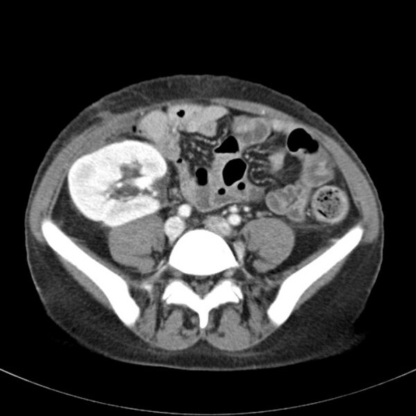 File:Biliary necrosis - liver transplant (Radiopaedia 21876-21846 B 53).jpg