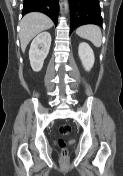 File:Bleeding duodenal ulcer and adenomyomatosis of gallbladder (Radiopaedia 61834-69861 B 25).jpg