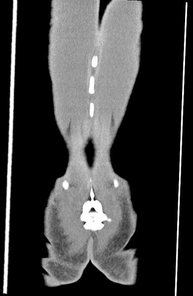 File:Blunt injury to the small bowel (Radiopaedia 74953-85987 B 92).jpg