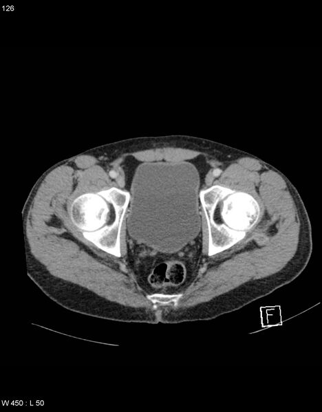 File:Boerhaave syndrome with tension pneumothorax (Radiopaedia 56794-63603 A 63).jpg