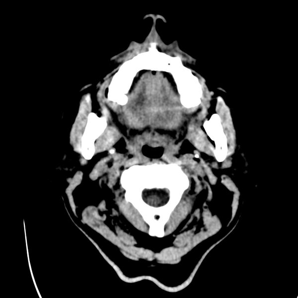 File:Brain Pantopaque remnants (Radiopaedia 78403-91048 Axial non-contrast 1).jpg