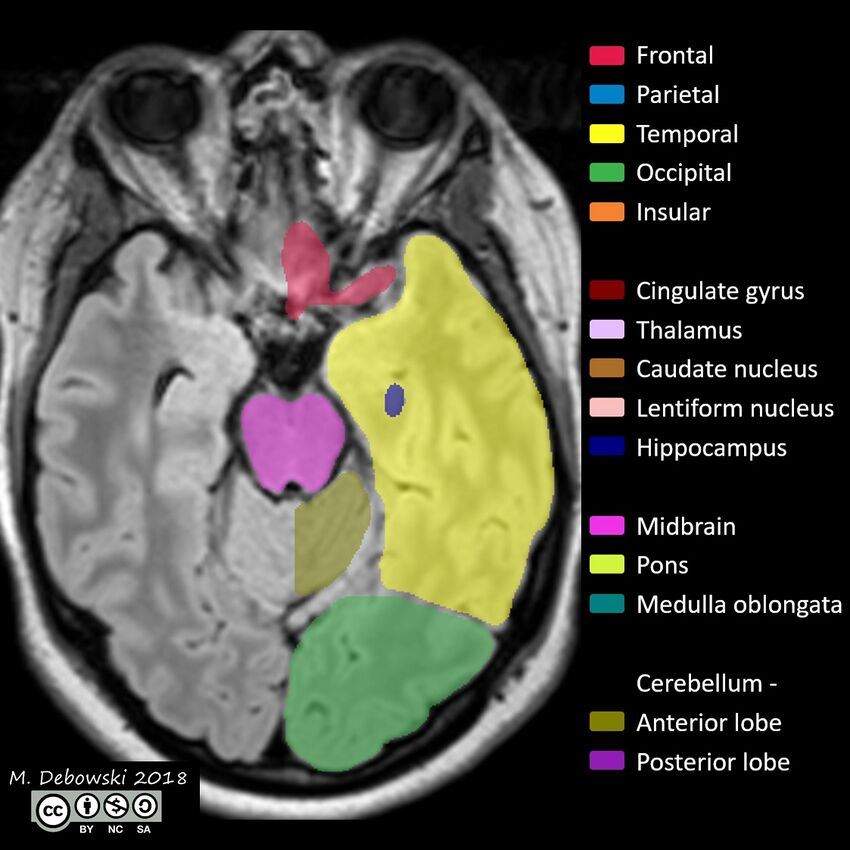 Brain lobes - annotated MRI (Radiopaedia 61691-69700 Axial 51).JPG