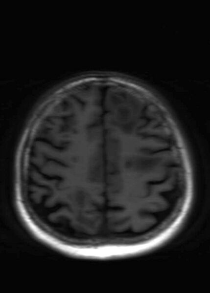 File:Brain metastases from squamocellular lung cancer (Radiopaedia 56515-63222 Axial T1 19).jpg