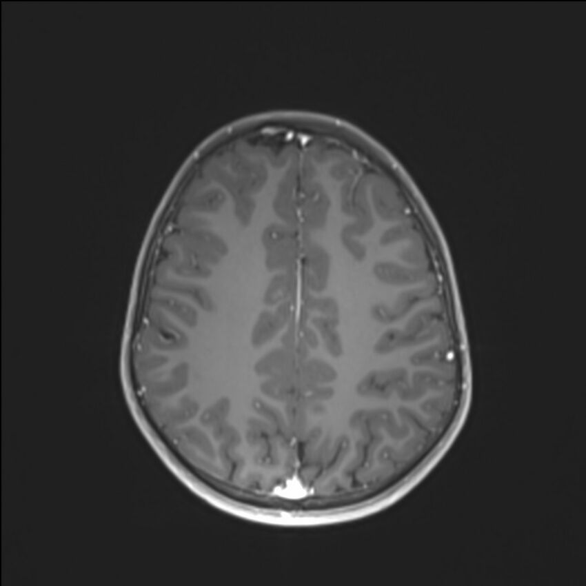 Brainstem glioma (Radiopaedia 70548-80674 Axial T1 C+ 112).jpg