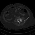 Breast carcinoma with pathological hip fracture (Radiopaedia 60314-67993 Axial bone window 8).jpg